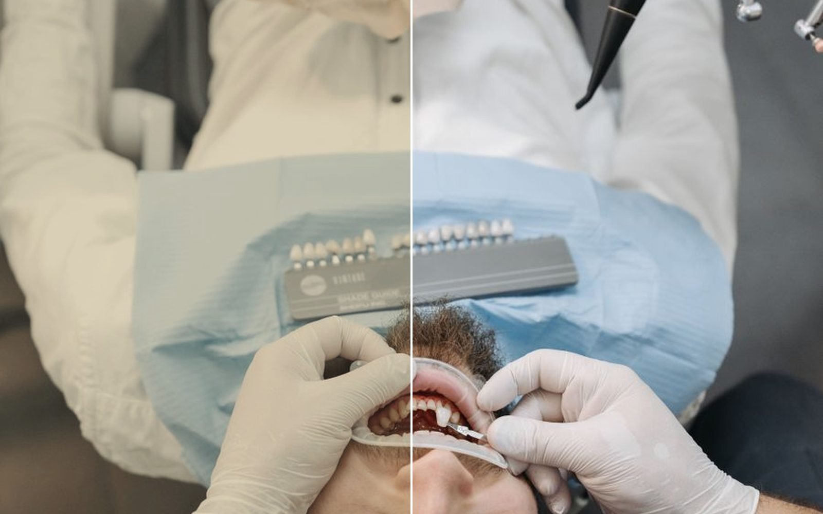 Laser whitening
